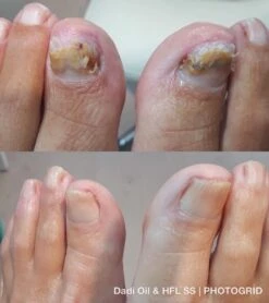 De Nummer 1 Tegen Schimmelnagels! - HFL - Laboratories - Solution Spray - 50ml + Dadi'Oil Nagelriem Olie - 3.75ml - Kalknagel Spray - Schimmelnagel Spray - Nagelriem Olie - Nagelverzorging -Lichaamsverzorging Winkel 1065x1200