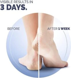 Scholl Klovenzalf - K+ Creme - Voor Hielkloven En Ruwe, Droge Huid -Lichaamsverzorging Winkel 1094x1200