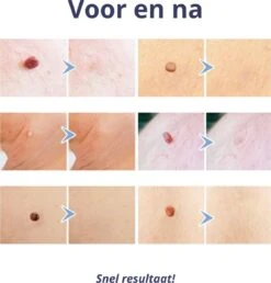 Steelwratjes Verwijderaar - Steelwratjes Verwijderen - Pijnloos En Snel - Wrattenverwijderaar - Steelwratten -Lichaamsverzorging Winkel 1148x1200