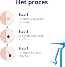 Steelwratjes Verwijderaar - Steelwratjes Verwijderen - Pijnloos En Snel - Wrattenverwijderaar - Steelwratten -Lichaamsverzorging Winkel 1154x1200