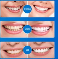 B-care Tanden Bleekpen - Teeth Whitening Pen - Tanden Bleker - Wittere Tanden - Teeth Whitening Strips - Professioneel Resultaat - Tandsteen Verwijderaar - Zonder Peroxide - Tandenbleekset - Tanden Bleken -Lichaamsverzorging Winkel 1170x1200 2