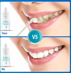 B-care Tanden Bleker – Wittere Tanden – Teeth Whitening Strips – Professioneel Resultaat - Tandsteen Verwijderaar - Zonder Peroxide - Tandenbleekset - Tanden Bleken -Lichaamsverzorging Winkel 1177x1200 4