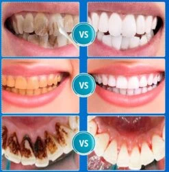 B-care Tanden Bleker – Wittere Tanden – Teeth Whitening Strips – Professioneel Resultaat - Tandsteen Verwijderaar - Zonder Peroxide - Tandenbleekset - Tanden Bleken -Lichaamsverzorging Winkel 1181x1200 3