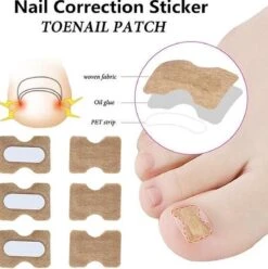 Teennagel Lifter I Ingegroeide Teennagel Corrector I Teennagel Pleister I Anti Ingroei Pleister I Nagel Correctie Kit I 30 Stuk