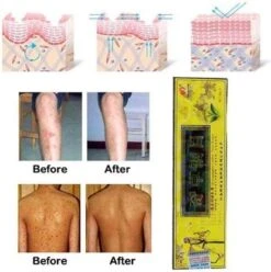 Psoriasis/exzeem Chineese Creme 15 Psoriasis/exzeem Chineese Creme -Lichaamsverzorging Winkel 1195x1200 8
