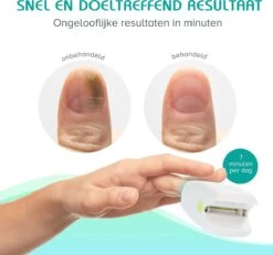 Anti Schimmelnagel Zelf-laserapparaat Incl. Pedicure Set 15 Anti Schimmelnagel Zelf-laserapparaat Incl. Pedicure Set -Lichaamsverzorging Winkel 1200x1120 1