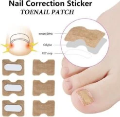 Merkloos Ingegroeide Teennagel Corrector