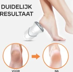 MW® Elektrische Eeltverwijderaar - Voetvijl - Eelt Verwijderaar - Elektrische Vijl - 3 Vijlschijven -Lichaamsverzorging Winkel 1200x1191