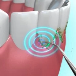 Toppers Van TV - Sonic Tandsteenverwijderaar - Tandplakverwijderaar -Lichaamsverzorging Winkel 1200x1200 1245