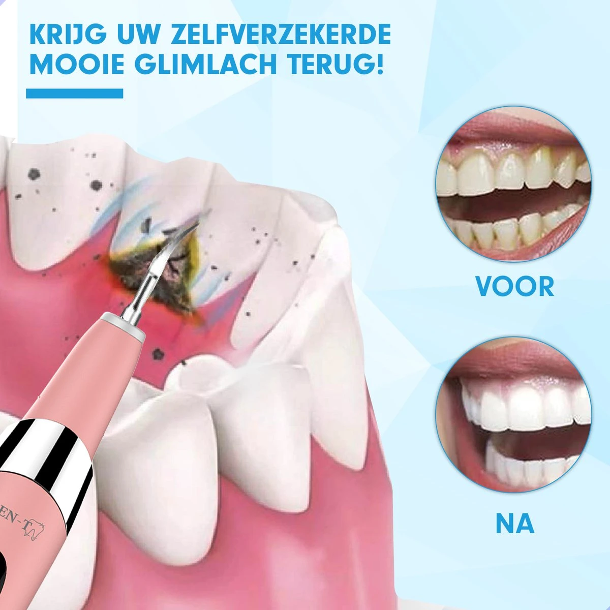 DEN-T® PRO U500 - Elektrische Sonische Tandsteen Verwijderaar - Roze 10 DEN-T® PRO U500 - Elektrische Sonische Tandsteen Verwijderaar - Roze - Afbeelding 8