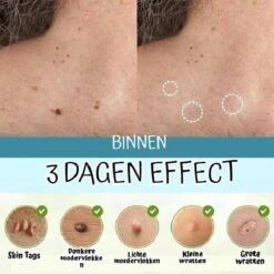 Skini™ - Moedervlekken & Wratten & Skin Tags Verwijderaar | Moedervlekken Verwijderaar | Wratten Verwijderaar | Moedervlekken Verwijderen | Wratten Verwijderen | Fibroom Verwijderen | Skin Tag Verwijderen | Steelwratjes Verwijderen -Lichaamsverzorging Winkel 1200x1200 461