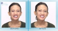 Tand Afgebroken Reparatie Kit InstantSmile Gebit (goedkope Kunstgebit) - Multi Shade -Lichaamsverzorging Winkel 1200x639