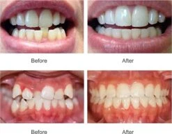 SAMA Direct™ Rechte Tanden Zonder Beugel - Orthodontische Bitjes - Rechte Tanden Bitje - Beugel - Knarsbitje - Nachtbeugel - Knarsen Bitje - Rechte Tanden - Witte Tanden 10 SAMA Direct™ Rechte Tanden Zonder Beugel - Orthodontische Bitjes - Rechte Tanden Bitje - Beugel - Knarsbitje - Nachtbeugel - Knarsen Bitje - Rechte Tanden - Witte Tanden -Lichaamsverzorging Winkel 1200x938 1