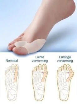 MYCARE+ Teencorrector - Wasbare Teencorrector - Gel-laag - 1 Paar - Pijn Verlichtend -Lichaamsverzorging Winkel 890x1200 1